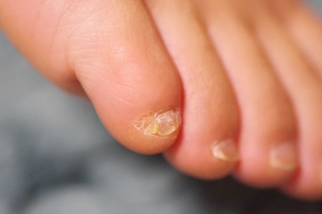 足の小指の爪」がよく剥がれる…なぜ？ 2枚に分かれて生える原因は