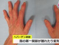 “手のしびれや指の痛み”実は「メノポハンド」かも？　更年期女性は特に注意　発症抑える3つのストレッチ法
