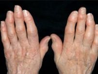 梅雨時期に増える“指”の痛み 原因は女性ホルモンの急減かも 関節が変形する「ヘバーデン結節」　最新治療と予防法を専門医が解説