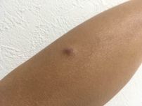 皮膚に現れた「できもの」の正体（1）蚊に刺されてできた黒く硬いしこりが治らない