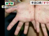 すでに流行状態　長崎県で手足口病の患者が増加