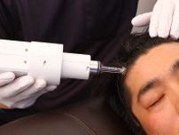 【薄毛治療の最前線】日本初の針なし注射で毛髪再生！注目のAGA治療「幹細胞培養上清液毛髪再生治療」とは？