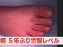 手足口病が警報レベル超え　乳幼児への感染注意喚起