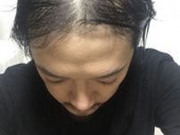 「頭髪に悩む中年男性」が絶対にやってはいけない“コスパ最悪の薄毛対策”