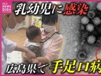 「手足口病」感染拡大　広島県で２年ぶりに「警報」発令　小児科医「まずは規則正しい生活を」