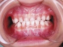 「反対咬合（受け口）」は幼少期から治療を　放置すると下あごの骨が異常に発達する可能性　負担の少ない装置も登場