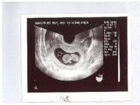 妊娠初期の超音波検査で確認できることは？ 赤ちゃんの性別はいつごろわかる？【産婦人科医】