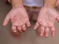 「手足口病」が流行中、各地で警報が！「突然の熱から手と足、おしりにブツブツが･･･」子どもから親にうつることも。予防策は？【小児科医】